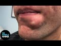 SATISFYING! Dr Lee Pops Inflamed Cyst on Chin | Dr Pimple Popper Reacts