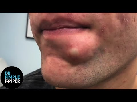 Pimple Popper