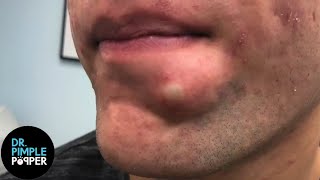 SATISFYING! Dr Lee Pops Inflamed Cyst on Chin | Dr Pimple Popper Reacts