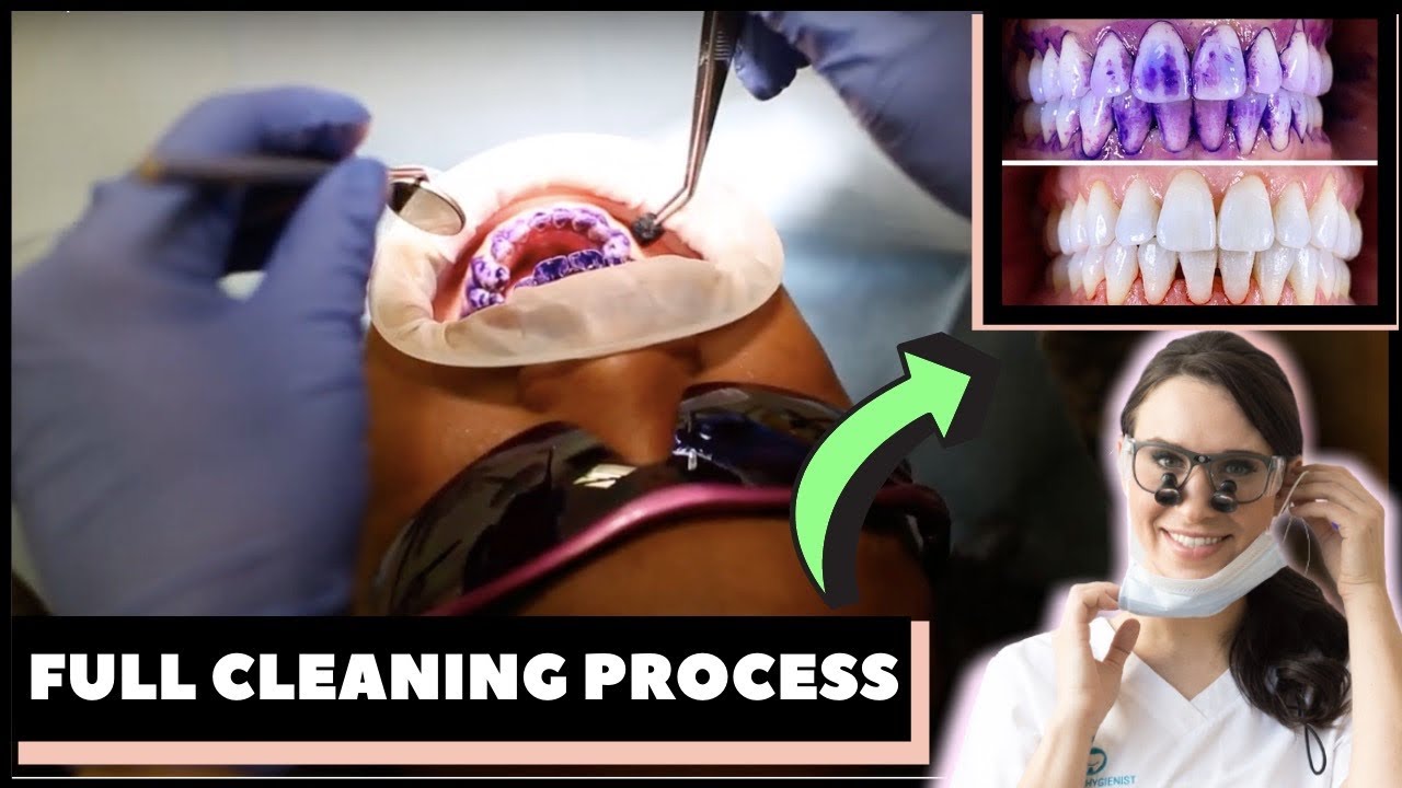 HOW TEETH ARE CLEANED AT THE DENTIST |  Step-by-Step Guided Biofilm Therapy