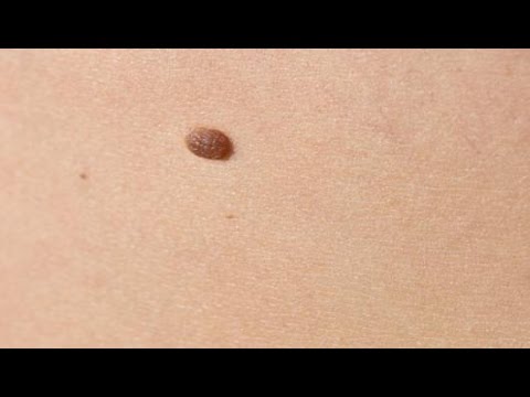 Kolla dina leverfläckar under melanomveckan 9-13 maj