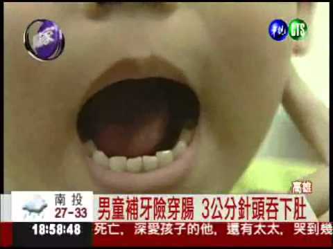 "針"離譜! 3歲童補牙誤吞針頭