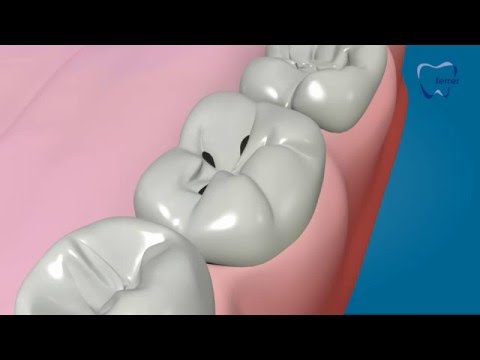 Selladores dentales