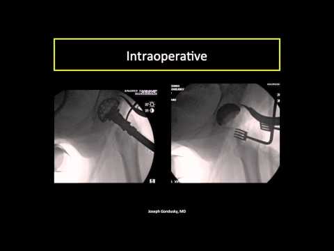 Perfecting Component Placement in Anterior Approach Total Hip Arthroplasty