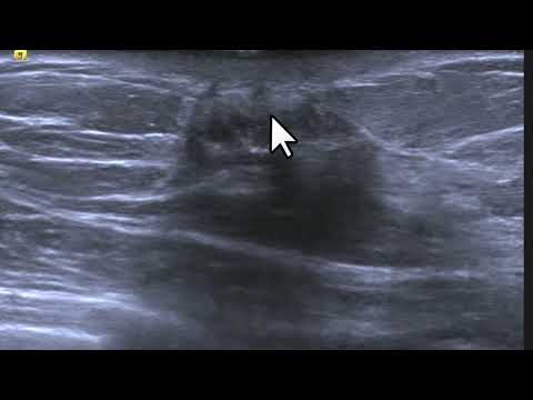 Progresão do câncer de mama para a pele. Achados clínicos e ultrassonográficos