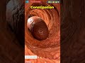 Constipation Human Anatomy Bio AI Art 01