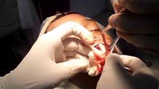 preview picture of video 'LIP REDUCTION SURGERY (Lower Lip) By Dr. Umesh Shah, Vadodara'