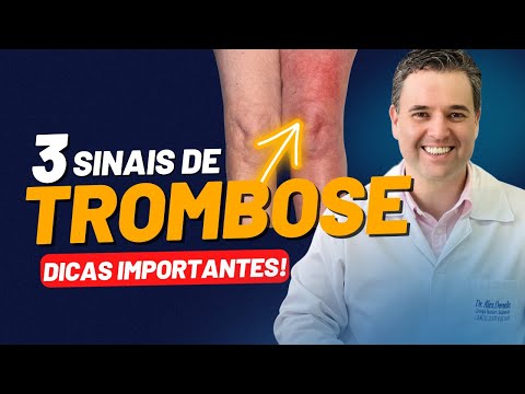 TROMBOSE | Sintomas e causas da trombose. Como identificar os sinais da trombose??