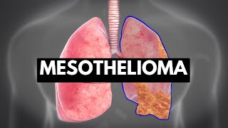 Mesothelioma: Causes, Symptoms, and Treatment