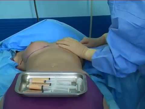 Breast lipofilling with BODYJET by dr Bergeret