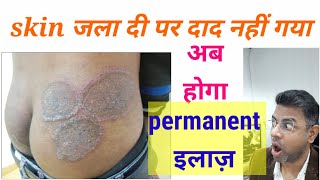Fungal infection permanent treatment I Daad ka ilaj l Dr. Anil Mohite M.D