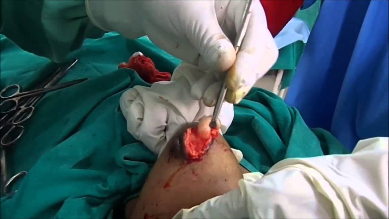 A Big Fibrodenoma Removal through a small incision