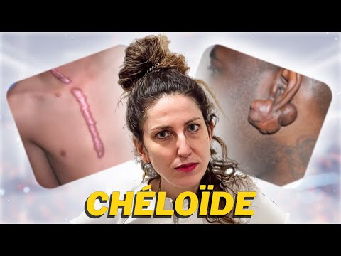 Keloid scar what to do?!