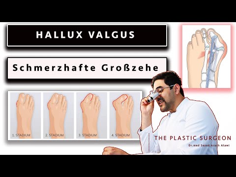 Hallux Valgus Surgery | Hallux Valgus: 3 Key Points | Disease | Treatment