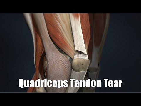 Quadriceps Tendon Tear