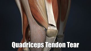 Quadriceps Tendon Tear