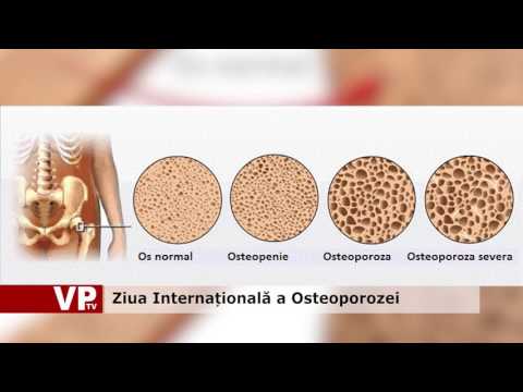 Ziua Internațională a Osteoporozei