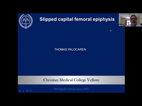 TO PASS DNB/MS ORTHOPAEDICS -CASE 99- SCFE- SLIPPED CAPITAL FEMORAL EPIPHYSIS - DR. THOMAS PALOCAREN