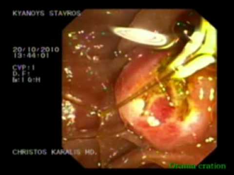 Needle Knife Removal Of Gallstones From Common Bile Duct - ERCP