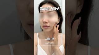 울쎄라 300샷 효과는 어떨까?