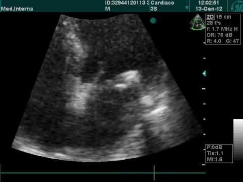 Mitral- und Aortenstenose bei der Echountersuchung