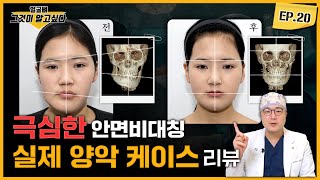 극심한 안면비대칭, 실제 양악 케이스 리뷰👨‍⚕️｜얼굴뼈그알｜임종우 원장