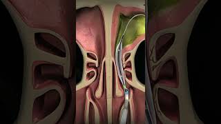 Balloon Sinuplasty Procedure - To Open Blocked Sinus Passages#complications #tonsillar #tipss
