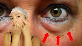 How to get rid of under EYE BAGS and DARK CIRCLES