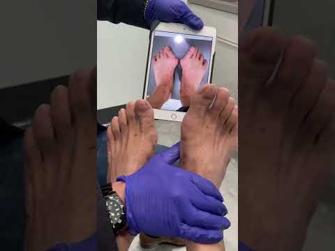 Life changing foot transformation