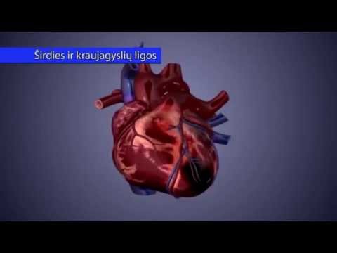 kaip gydyti širdies hipertenziją