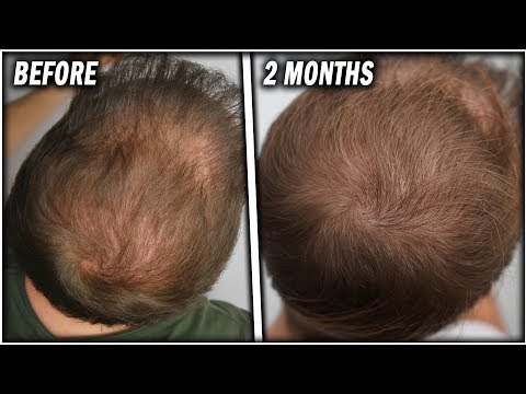 Topical Finasteride 2 Months before and after!