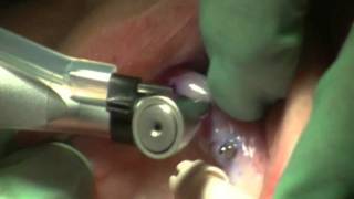 Mini Dental Implants Live Procedure