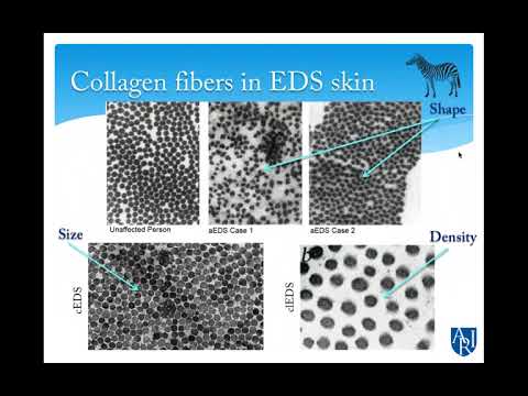 EDS & Other Hypermobility Spectrum Disorders in ASD
