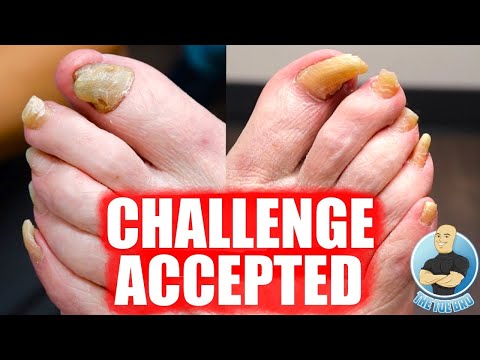 TOENAILS TOO THICK AND HARD TO CUT???