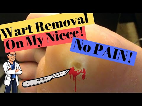 HUGE Foot PIMPLE filled with dead FAT Crystals