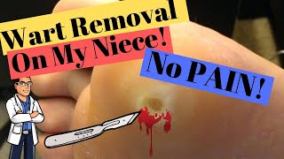 Plantar Wart Removal: How to Get Rid of a Foot Wart with No PAIN!