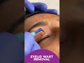 Are the eyelid warts taking away your charm? | #eyelid #like #eyelidwarts