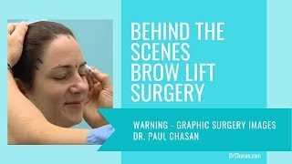 preview picture of video 'Brow Lift by Del Mar Cosmetic Surgeon Dr Paul Chasan'