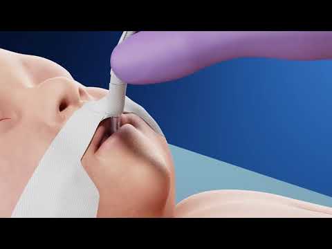 Endotracheal Tube Securement - Demonstration of H Technique