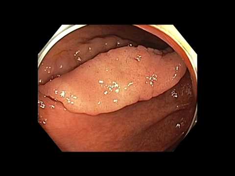 Colonoscopia : Pólipo LST-G del colon ascendente - EMR