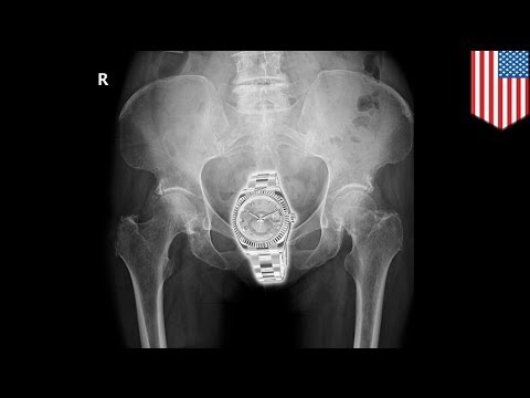 Kung ano ang magsanay na maaari mong gawin sa spinal hernia alisin tiyan taba Institute of Nutrition Timbang Pagkawala Clinic