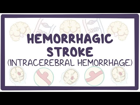 Hemorrhagic stroke: intracerebral hemorrhage - causes, symptoms, diagnosis, treatment, pathology