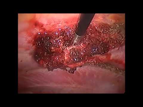Rib Tumour Excision By VATS