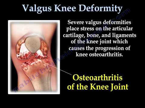 Déformation du genou en valgus - Tout ce que vous devez savoir