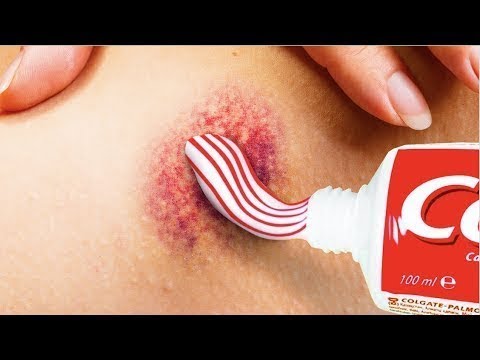 Hebe- und Ellbogen Wenn die wunden Kälber und Gelenke
