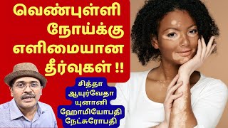 Vitiligo treatment – Ayurveda, Siddha, Unani, Homeopathy, Naturopathy Medicines