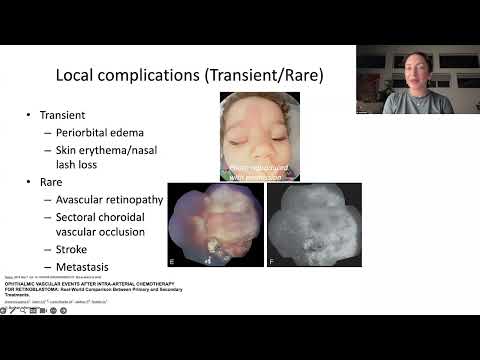Lecture: Innovations and Advances in Retinoblastoma Management