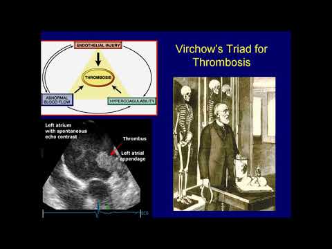 Ablation of AF can prevent stroke: NO