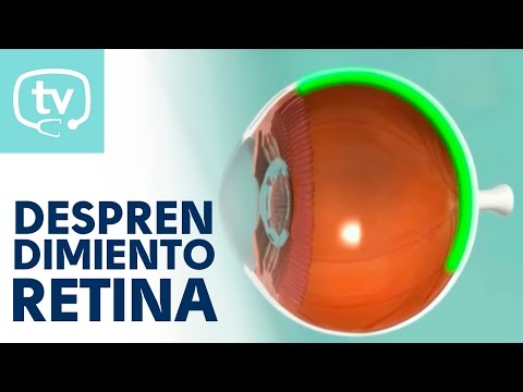 El desprendimiento de retina