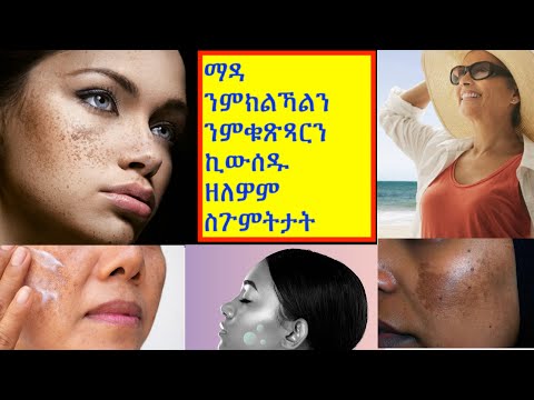 ማዳ እንከላኸለሉን እንቆጻጸረሉን መንገድታት ( Prevention and treatment of melasma)- Part 2 (ካልኣይ ክፋል)